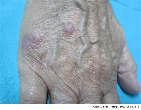Violaceous Papules On The Dorsum Of The Hand Actas Dermo Sifiliográficas