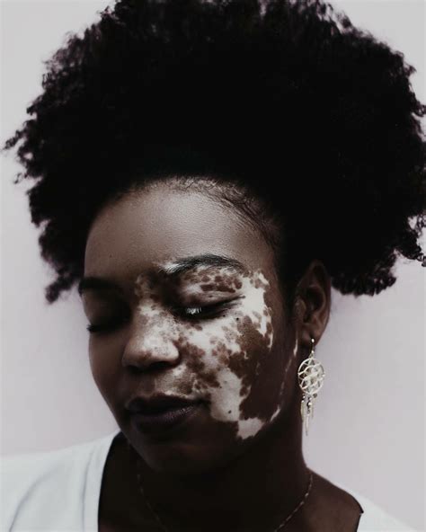 Black Girls R Magic — Sabrina Castro Vitiligo Pretty People Vitiligo Treatment