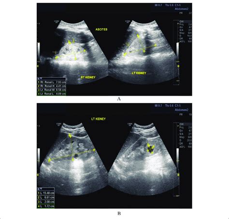 Sonograms Showing Renal Echogenicity Grades 2 A And 3 B Download