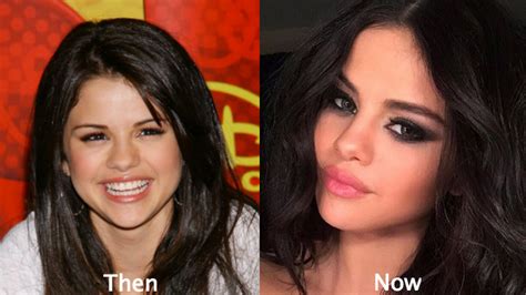 selena gomez plastic surgery before and after photos