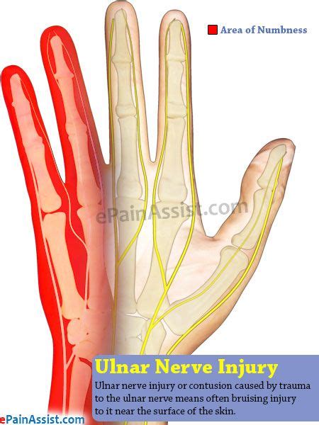Ulnar Nerve Injury Causes Symptoms Treatment Ulnar Nerve Ulnar