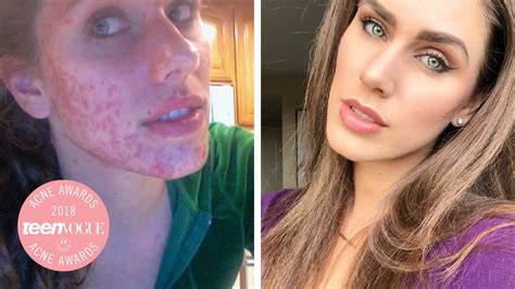 Cassandra Bankson On The Truth Behind Her Cystic Acne Teen Vogue