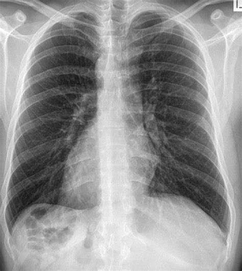 Encontre imagens stock de chest xray image dextrocardia situs inversus em hd e milhões de outras fotos, ilustrações e imagens vetoriais livres de direitos na coleção da shutterstock. Dextrocardia - Treatment, Symptoms, Diagnosis, Causes ...