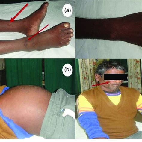 Photographs Of Patient Showing Pitting Edema Over The Left Legs Thick