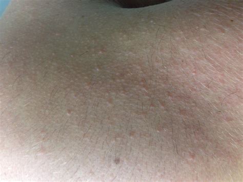 White Bumps On Left Arm Will It Turn Into Scars
