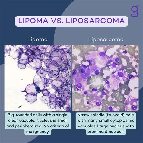 Lipoma Vs Liposarcoma How To Tell The Difference