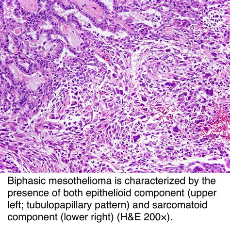 Peritoneal mesothelioma is a cancer of the peritoneum, the lining of the abdomen. Pathology Outlines - Peritoneal malignant mesothelioma