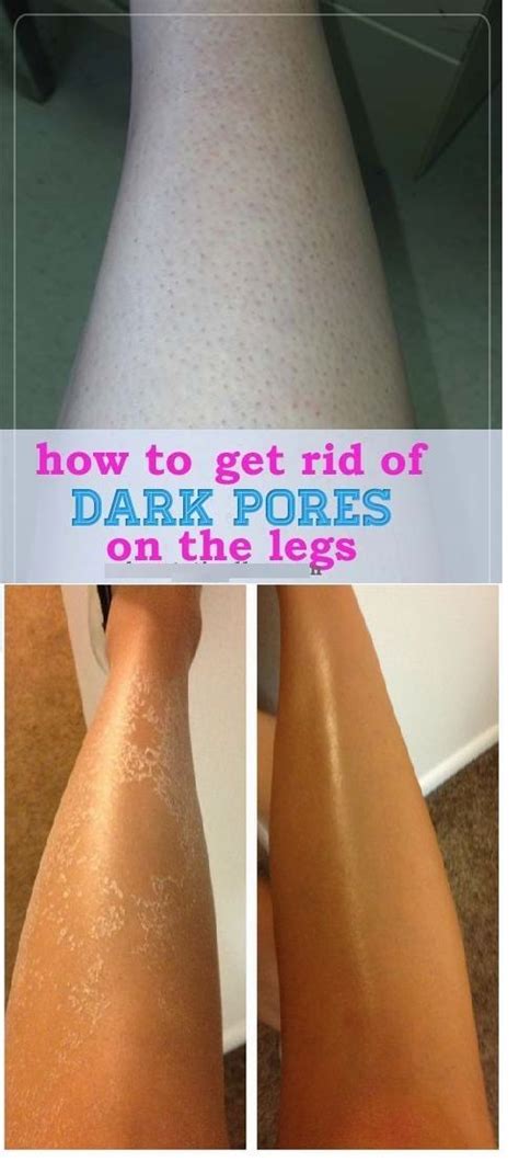 You can also use one of several if the dog is scratching and seems to be irritated, medication may be required. Many women end up dealing with dark pores on their legs ...