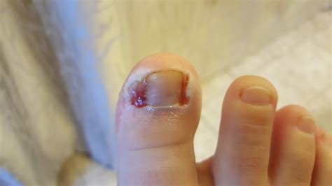 I Am A Type 1 Diabetic Warrior If You Ever Decide To Have Ingrown Toe