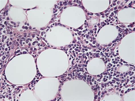 Pathology Outlines Lupus Panniculitis