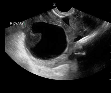 hemorrhagic cyst on ultrasound