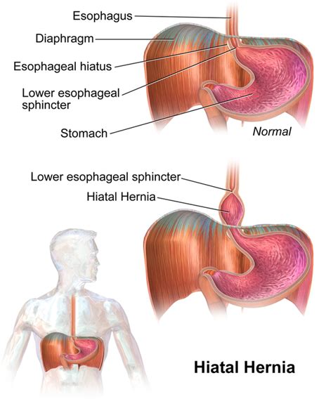 Hiatus Hernia Exercise Best Exercises For Hiatal Hernia You Must Know Youtube Hiatal