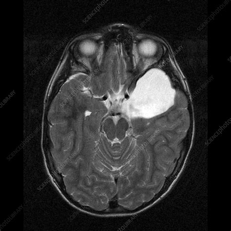 Arachnoid Cyst Mri Scan Stock Image M1300944 Science Photo Library
