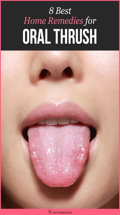 Home Remedies For Oral Thrush Here Are Some Best Natural Remedies That Control The Infection