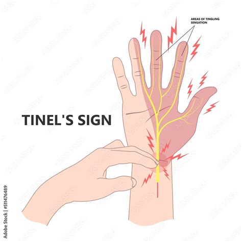 Tinels And Phalens Sign Test For Carpal Tunnel Syndrome Compressed Hand With Guyons Canal