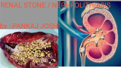 Renal Stones Nephrolithiasis Youtube
