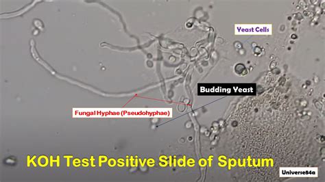 Koh Test Positive Slide Of Sputum Introduction Principle Procedure