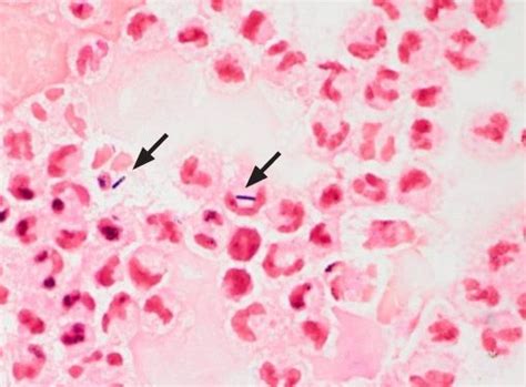 Haemophilus influenzae gram stain neisseria meningitidis gram stain listeria monocytogenes gram stain virulence factors of bacteria upper respiratory tract infection. Listeria intracellular | Medical pictures, Abstract ...