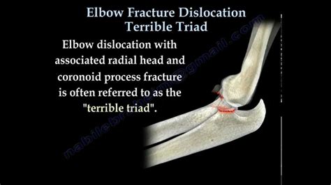 Elbow Fracture Dislocation Terrible Triad Everything You Need To Know