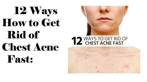 12 Ways To Get Rid Of Chest Acne Fast Chest Acne Acne Health And