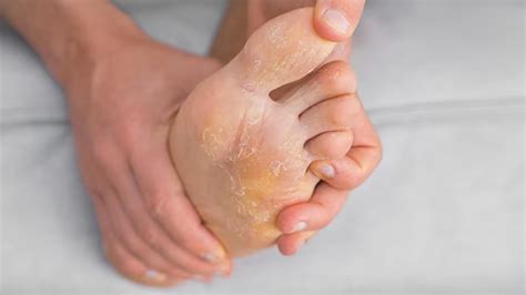 Causes And Preventive Measures For Foot Peeling Onlymyhealth