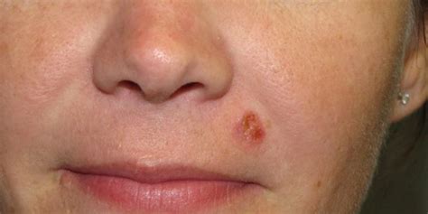 Squamous Cell Carcinoma Lip Skin Cancer And Reconstructive Surgery