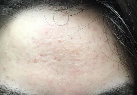 Skin Concern How Can I Get Rid Of This Texture On My Forehead R