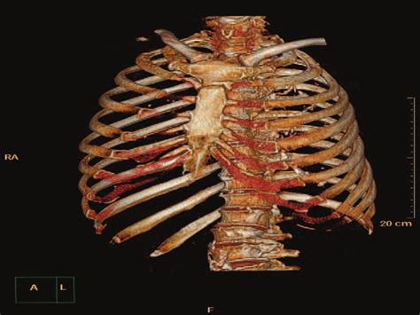 Three Dimensional Image Of Ribs Reconstruction The Abnormality Was