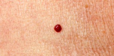 Also known as vascular birthmarks or infantile hemangiomas, they usually cause no problems aside from their appearance and often go away. Cherry Angiomas | Associated Skin Care Professionals