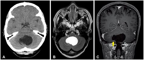 Fourth Ventricle Neurenteric Cyst Mimicking Hemangioblastoma
