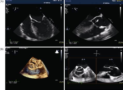 Transesophageal Echocardiography A Four Chamber View Aortic