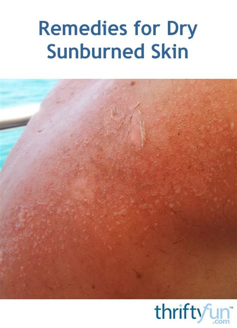 Remedies For Dry Sunburned Skin Thriftyfun