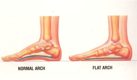 Flat Foot Deformity