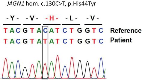 Mutation Analysis Of The Patient By Sanger Sequencing Download Scientific Diagram