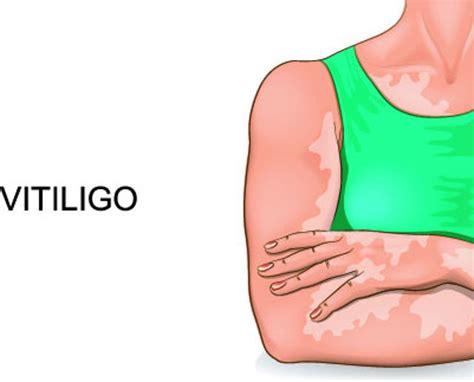 Vitiligo