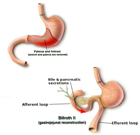 Figure Afferent Loop Anatomy Image Courtesy S Bhimji Md