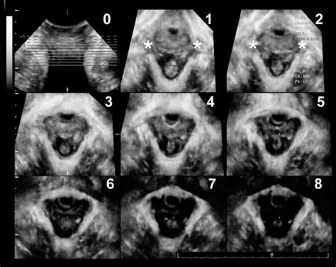 Tomographic Ultrasound Imaging Of The Pelvic Floor Which Levels Matter