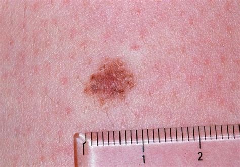 Intradermal Naevus On Human Skin Photograph By Dr P Marazziscience
