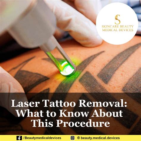 Laser Tattoo Removal What To Know About This Procedure