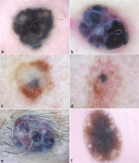 Benign Lesions With Blue Color Blue Nevus With Structureless Blue