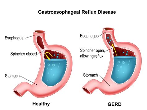 Gastroesophageal Reflux Disease By Tigatelu On Dribbble