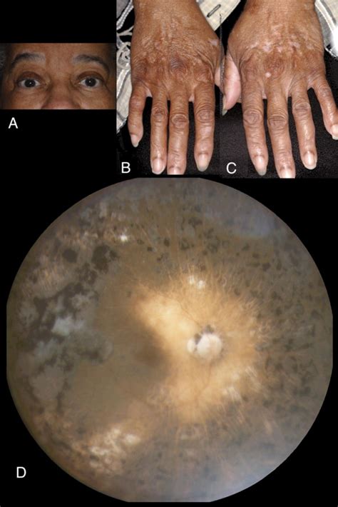 Choroidal Vitiligo Masquerading As Large Choroidal Nevus