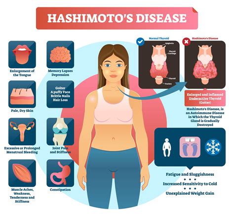 Pathophysiology Clinical Presentation And Diagnosis Hashimoto S Disease