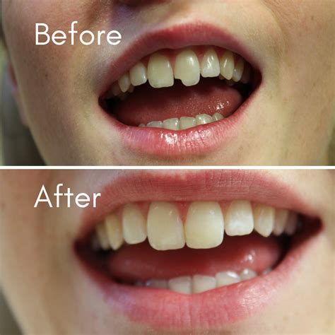 Broken Teeth Chipped Teeth Cracked Tooth Repair General Dentistry