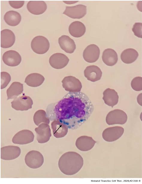 Critical Blue Green Inclusions In Neutrophil And Monocyte Cytoplasm In