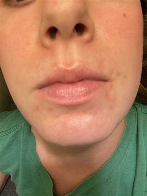 [acne] scars from 6 months ago help skincareaddiction