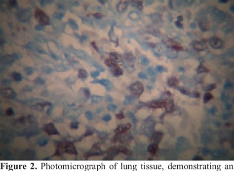 Figure 1 From Eosinophilic Granuloma Of The Lung And Rib Semantic Scholar