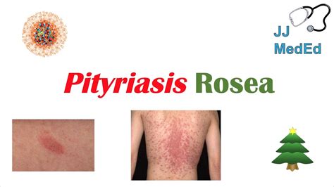 Introduction To Pityriasis Rosea Possible Causes Symptoms And Treatment YouTube