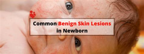Common Benign Skin Lesions In Newborn Babies Motherhood Chaitanya