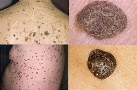Many — But Not All — Skin Lesions Are Harmless Msr News Online